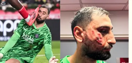 Gianluigi Donnarumma Facial Injury